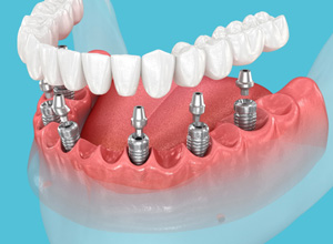 Illustration of implant dentures for lower arch