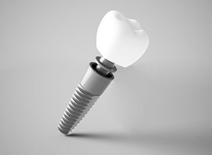 Dental implant and crown pictured against gray background