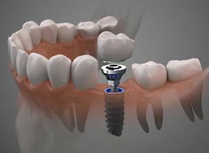Illustration of single dental implant between natural teeth