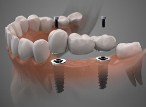 Illustration of three-unit dental implant bridge