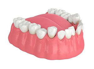 Illustration of crowded teeth against white background