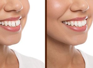 Woman’s smile before and after closing gap with clear aligners