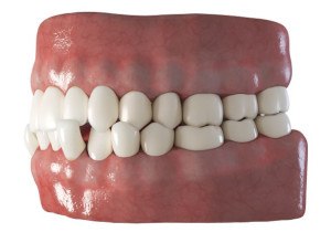 Three-dimensional illustration of a crossbite