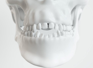 Illustration of human facial bones and teeth with an open bite